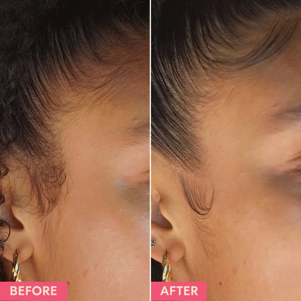 Before and after close-up of woman's hairline smoothing, showcasing beauty product results