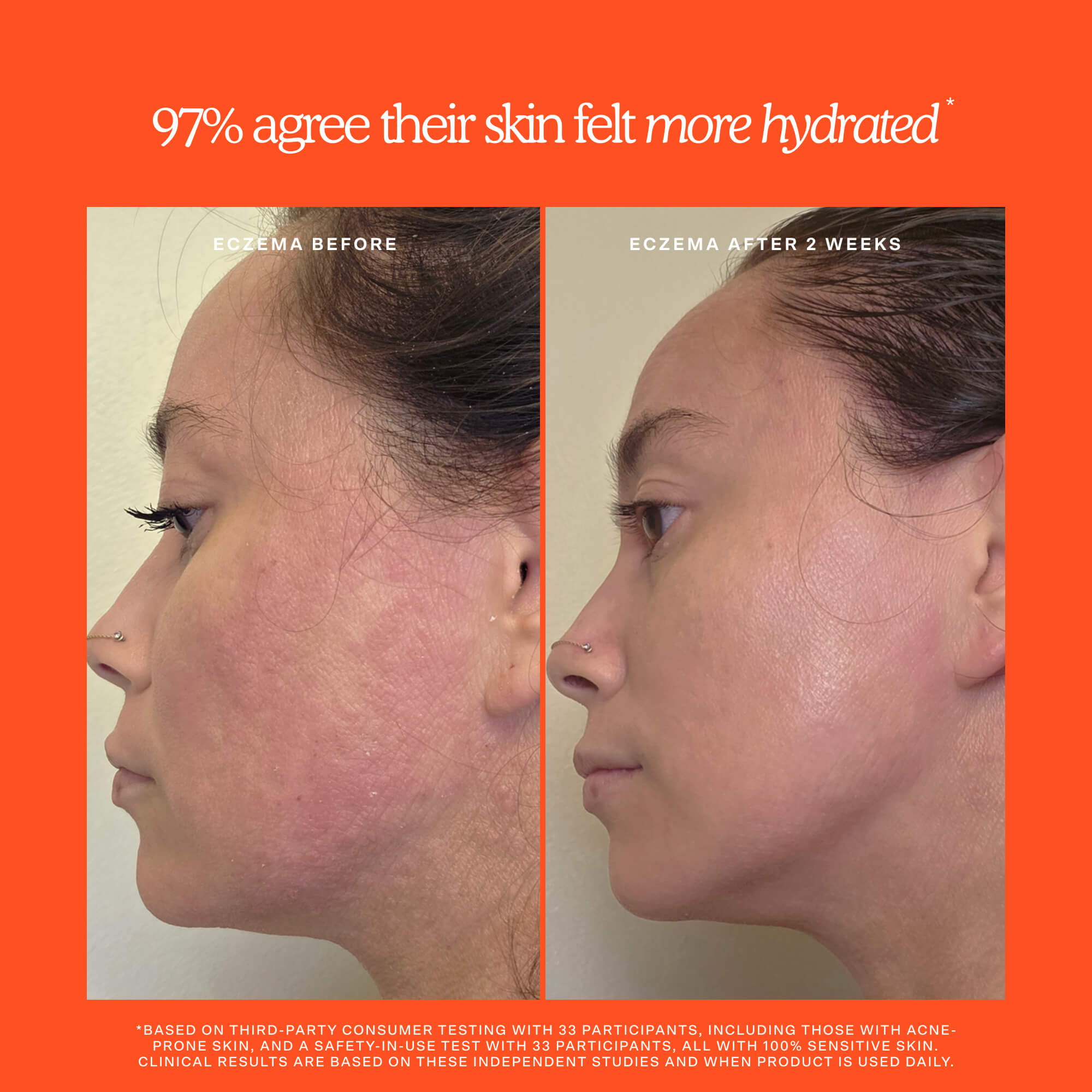 Before and after comparison of a person's face with eczema, showing improvement after 2 weeks on an orange background. [Shared]