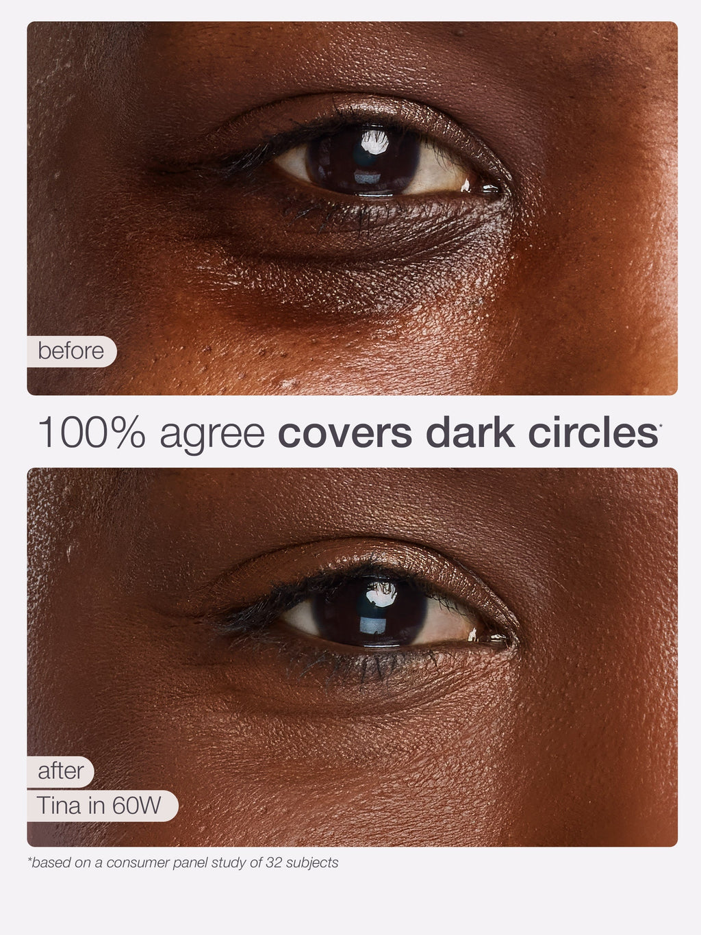 Before and after comparison of eye dark circles treatment on a person's eye.