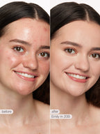 Before and after comparison of a woman's face with visible skin treatment effects.