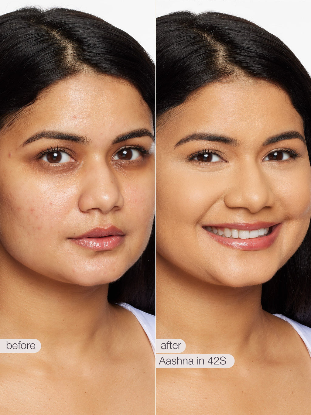 Before and after comparison of a woman's face with visible skin improvement using Aashna in 42S treatment.