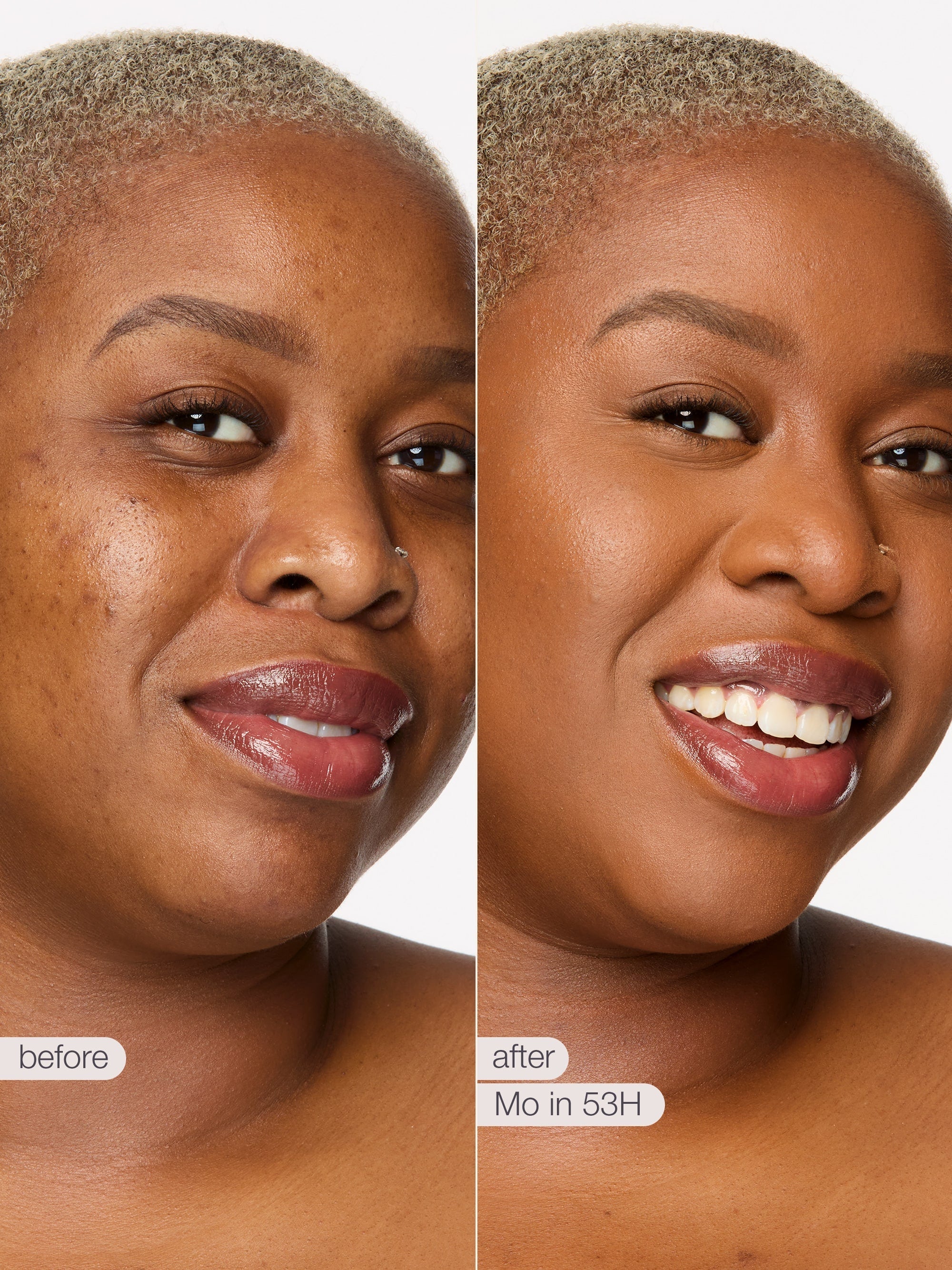 Before and after comparison of a woman's face with visible skin improvement.